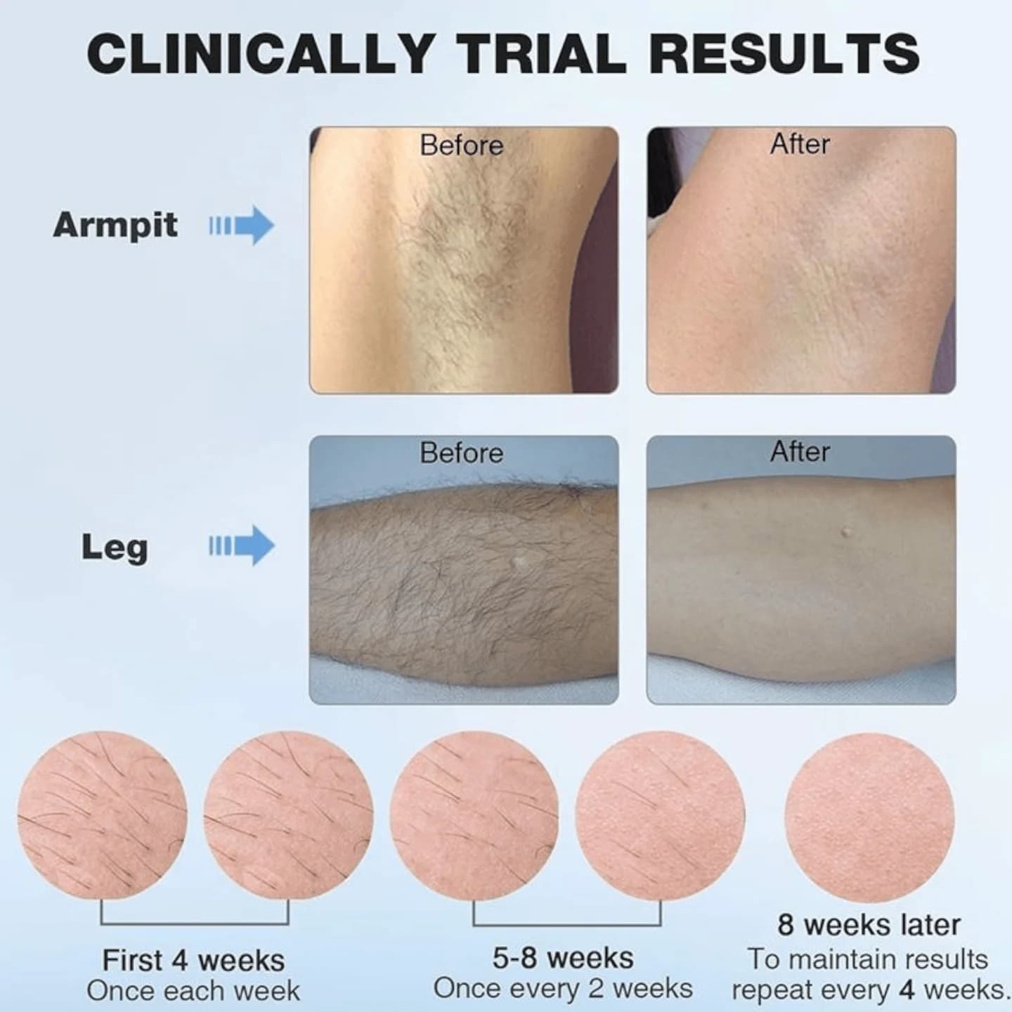 Uređaj za lasersku epilaciju s ledenim efektom 3